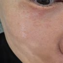 서정타워2차 | 평택 피부관리 리뉴엣 에스테틱, 고덕점에서 비립종이랑 홍조 잡고 온 찐 후기
