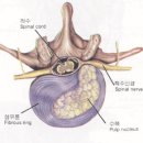 목 디스크 (경추간판탈출증) 이미지
