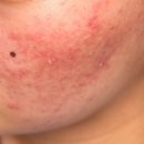 서울북성초등학교 | 서대문구피부과 화농성 여드름 치료 후기 (전 후 비교)