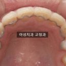 아성치과기공소 네이버블로그
