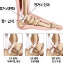 첫골 | [일상] 발목 인대, 불안정성, 연골, 석회화, 골유기체, 아킬레스, 수술 후기 #1(발목, 족부 첫 진료 계기)