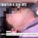 삼성필의원 | 수원젠틀맥스프로플러스 남자얼굴전체 앞목 수염제모 시술동영상 20260110 인계동 원스의원