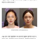 ㄹㅇ 성형 안해본 알못들이 윤곽으로 소두될수있는줄앎 이미지