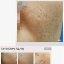 입주위여드름 | 왜 유독 입주위에만 여드름이 나는걸까? 입주위여드름! 이미지