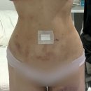 송도고운맘약국 | 인천 지방흡입, 송도 성형외과에서 지흡+골반 지방이식까지 하고 온 당일 후기 (붓기 관리 tip)