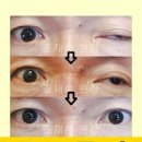 중증 근무력증 증상 및 치료 (눈꺼풀 처짐, 복시, 연하곤란) 이미지