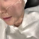 논현종합(실외)(6) | 신논현피부과 티타늄리프팅 80KJ 효과 통증 유지기간 리얼후기