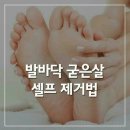 발바닥 굳은살 셀프 제거법 이미지