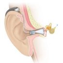 제일보청기 이미지