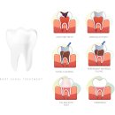 테라스치과의원 | 장기역치과, "신경치료 엄청 아프죠?" 지레 겁먹은 분들을 위한 통증 팩트체크