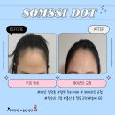 마산2 | 두피,헤어라인커버&amp;마산자연눈썹컨설팅[창원 마산] 솜씨 도트/2차관리 후기