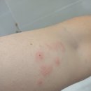 한미유치원 | [중국생활팁] 중국에서 대상포진 자가치료 후기 / 징동(京东)에서 온라인 처방받고 약 구매하는 방법