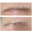 Estelle beauty(에스텔 뷰티) | 빨간잔흔 눈썹문신제거 후기 - 강남 잔흔제거 에스텔뷰티 찐후기