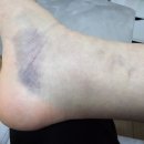 우리동네한의원 | [우리동네 한의원 추천] 타박상 멍, 붓기 빨리 빼는 법! 침/부항 치료 2회 만에 해결한 솔직 후기