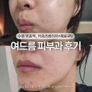 개스맨 | 수원 망포 여드름 카프리레이저 3회 효과,제로큐탄 약 후기
