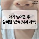 아이퍼스트치과병원 | 5살 남자아이 넘어진 후 앞이빨 변색, 치과 병원 치료 후기
