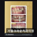 강남-106 | [강남 임플란트 치과/추천/후기] 서울크라운치과의원 통증 적고 꼼꼼한 진료로 호평
