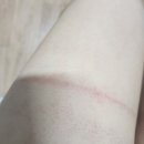 한양의지 | 한양대학교병원 산부인과 자궁근종 로봇 복강경 후기