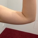 INFORMATION | 강남역 윔의원에서 팔뚝 지방분해주사 미우핏 1회차 진행 내돈내산 후기 맞게된이유 통증 관리법