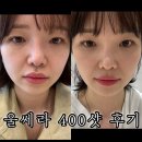 400 | 대구 성형외과 AI리프팅 울쎄라 400샷 후기
