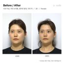 르수플