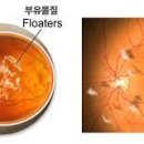 비문증[vitreous floaters] 이미지