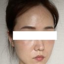 [강남역 여드름 피부과 시술 후기] M샤인주사EX 맞고 나서 2주차 후기