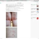 [공지]아토피완치 이야기 - 김완섭목사님 아토피후기및 추천서
