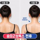 닥터정앤박날씬의원 | 영등포 승모근보톡스 전후 차이, 생각보다 큰 이유