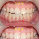 이사랑치과 네이버블로그