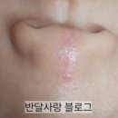 소아21 | 소아 안면열상 봉합 후기 21: 3차 레이저 후 일주일 경과
