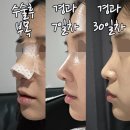 리얼미의원 | 무보형물코수술, 낮고 처진코끝교정 리얼후기🌿