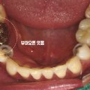 병소당 | 뿌리 끝 검은 병소 발치 즉시 임플란트, 상인동 치과