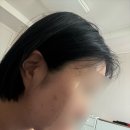 닥터이레이저피부과의원 | 닥터이레이저강남 압구정로데오 피부과 닥터이레이저피부과 여드름 치료 7-10회차