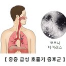 중증 급성 호흡기 증후군(Severe Acute Respiratory Syndrom) 이미지