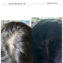 성원약국 - 서구 문정로 62 | [내돈내산] 엠발랑스 3년 장기 복용 후기 (1년·2년 비교, 출산 후 탈모 및 내돈내산 샴푸 추천)