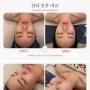 더원메디칼 | 새솔동피부관리 제대로 받고 온 후기 에스테틱단아_프리미엄 리프팅 윤곽관리