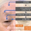 중년눈수술의 종류에 대하여 (간략하게)
