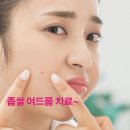 강북이지함피부과 | 좁살 여드름 치료, 피부 스케일링 효과적이예요~ 강북 노원 피부과