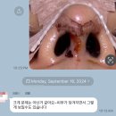 멍머리 | [비개방코성형]코끝,콧대,연골묶기 수술 3~5일차후기_붓기,멍,통증,머리감기