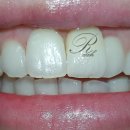 연세정의원 | 임플란트의 모든 것 (20대 앞니 임플란트 연세대학교 치과대학병원 후기)