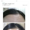 리메이드의원 | 이마 보톡스 후기