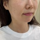 멍박스 | 인계동 피부과 다운타임 없는 텐써마 300 고현정리프팅 솔직 후기