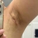 담소유병원 | [공지] 1달차까지/ 담소유병원 부유방 수술 후기