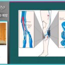 조금만 걸어도 다리가 무겁다면? 하지정맥류 의심해보세요! 이미지