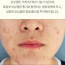 얼굴 모낭염 원인, 증상 및 치료 (등 다리 / 약 연고 항생제) 이미지