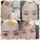 미모던피부과의원 | 강남필러, 관자놀이 이마 [미모던피부과의원]