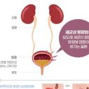 방광염 원인 증세 예방 검사 방광염에 좋은 음식 이미지