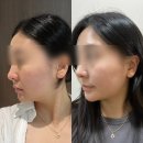 이뻐진개 | 신사역 피부과 이중턱슈링크 리프팅 주사 모두 가능한 이뻐 타이탄 패키지