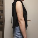 팔뚝지방추출6주차후기 이미지